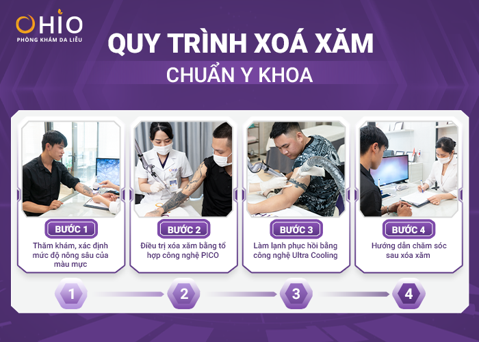 Xóa xăm Piconew 450 - Công nghệ xóa xăm tại phòng khám OHIO