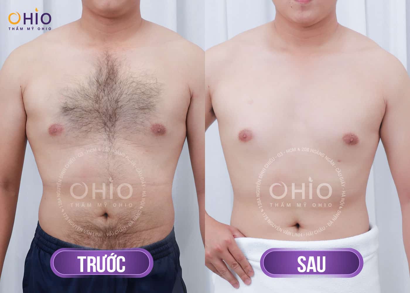 Triệt lông bụng nhanh chóng, hiệu quả an toàn 2025 - Phòng khám da liễu OHIO Triệt lông bụng nhanh chóng, hiệu quả an toàn 2025