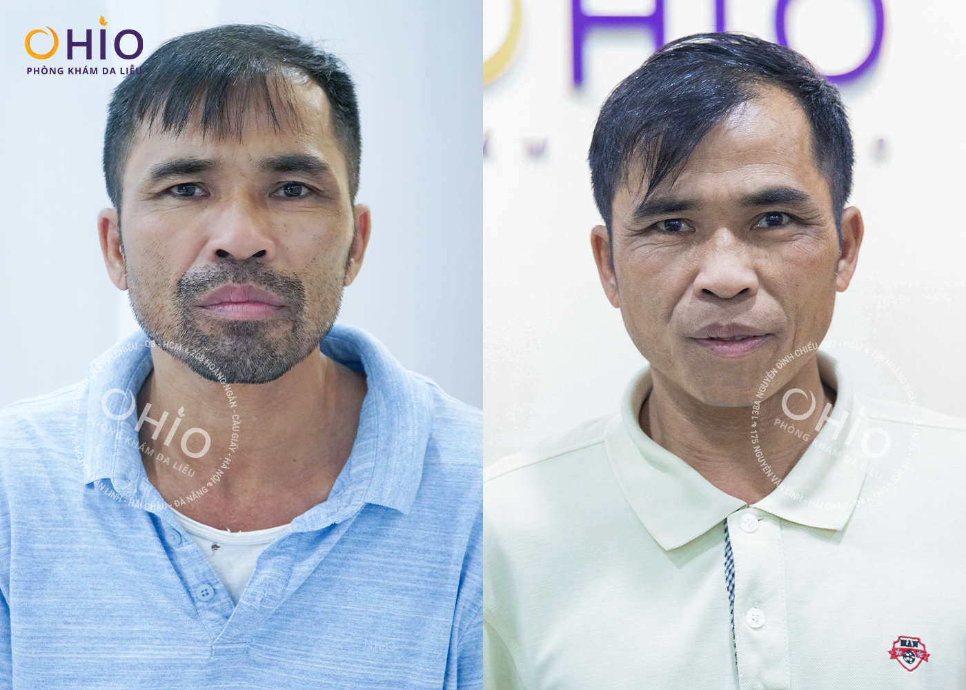 Triệt lông nam toàn thân và những điều cần lưu ý - Phòng khám da liễu OHIO Triệt lông nam toàn thân và những điều cần lưu ý