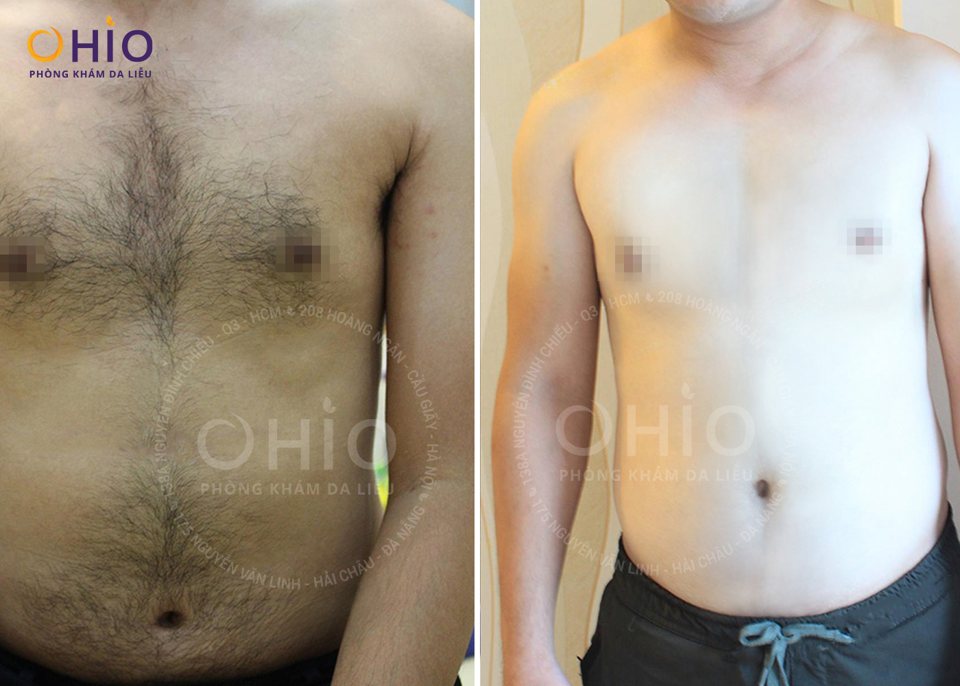 Triệt lông nam toàn thân và những điều cần lưu ý - Phòng khám da liễu OHIO Triệt lông nam toàn thân và những điều cần lưu ý