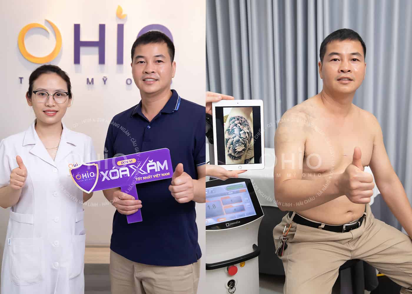 Địa chỉ xóa hình xăm ở Hà Nội - Phòng khám da liễu OHIO Địa chỉ xóa hình xăm ở Hà Nội