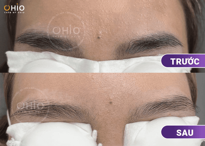 Xóa xăm lông mày loại bỏ mực xăm hiệu quả - Phòng khám da liễu OHIO Xóa xăm lông mày loại bỏ mực xăm hiệu quả