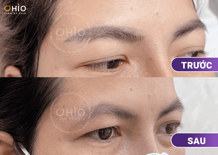 Xóa xăm lông mày loại bỏ mực xăm hiệu quả - Phòng khám da liễu OHIO Xóa xăm lông mày loại bỏ mực xăm hiệu quả