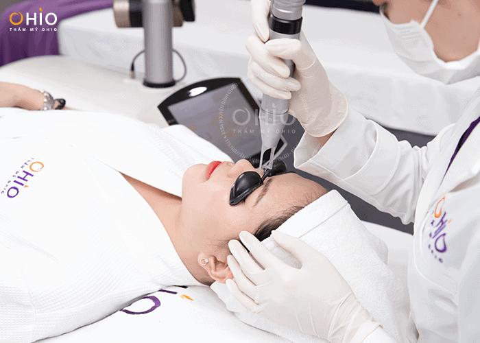 Xóa xăm lông mày loại bỏ mực xăm hiệu quả - Phòng khám da liễu OHIO Xóa xăm lông mày có thật sự hiệu quả không?