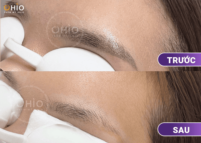Xóa xăm lông mày loại bỏ mực xăm hiệu quả - Phòng khám da liễu OHIO Xóa xăm lông mày loại bỏ mực xăm hiệu quả