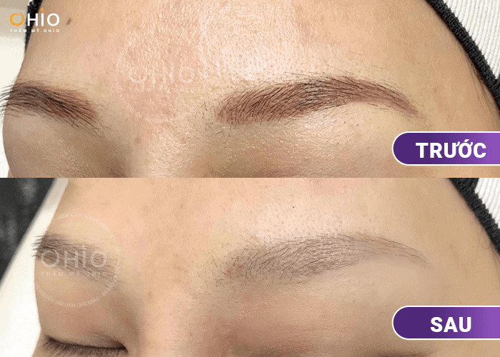 Xóa xăm lông mày loại bỏ mực xăm hiệu quả - Phòng khám da liễu OHIO Xóa xăm lông mày loại bỏ mực xăm hiệu quả