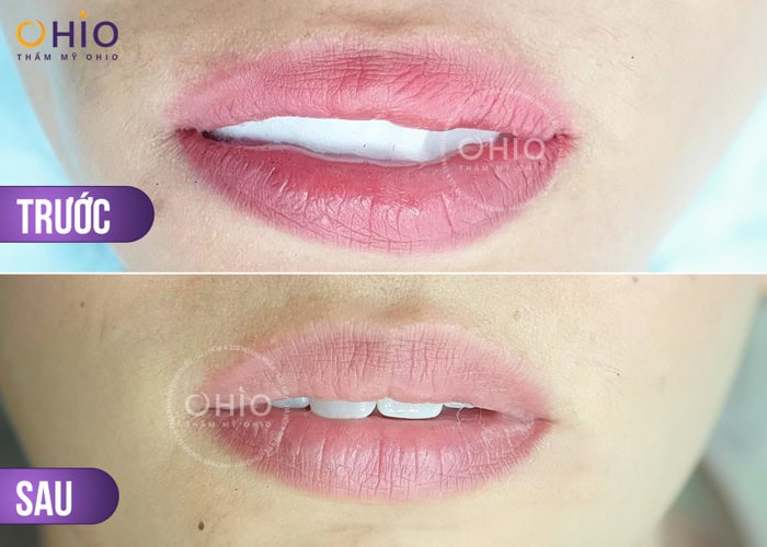 Xóa xăm môi hiệu quả - tối ưu thời gian