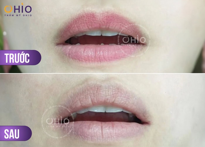 Xóa xăm môi hiệu quả - tối ưu thời gian