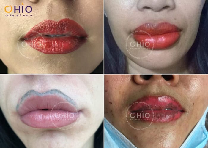 Xóa xăm môi hiệu quả - tối ưu thời gian