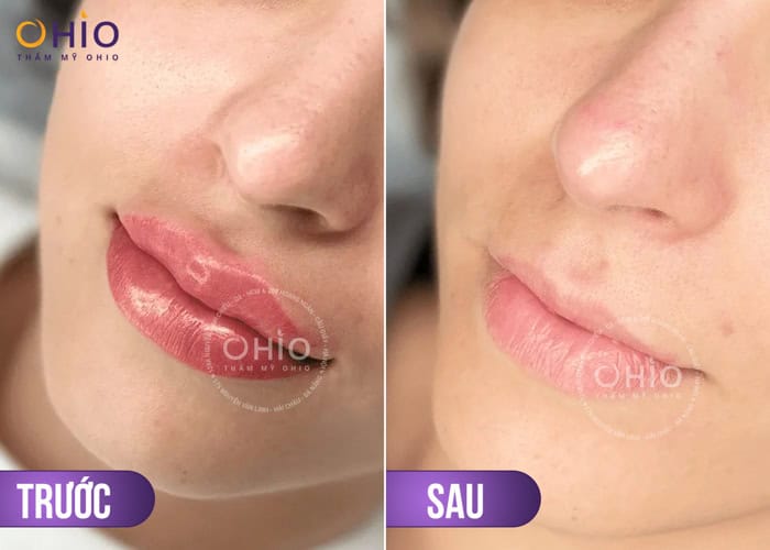 Xóa xăm môi hiệu quả - tối ưu thời gian