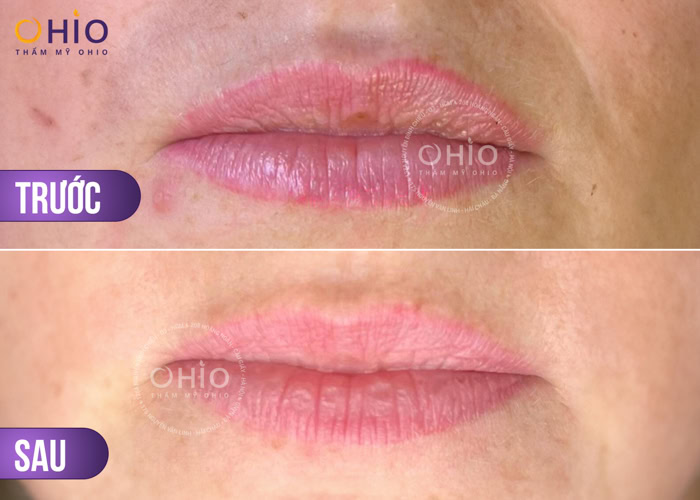 Xóa xăm môi hiệu quả - tối ưu thời gian