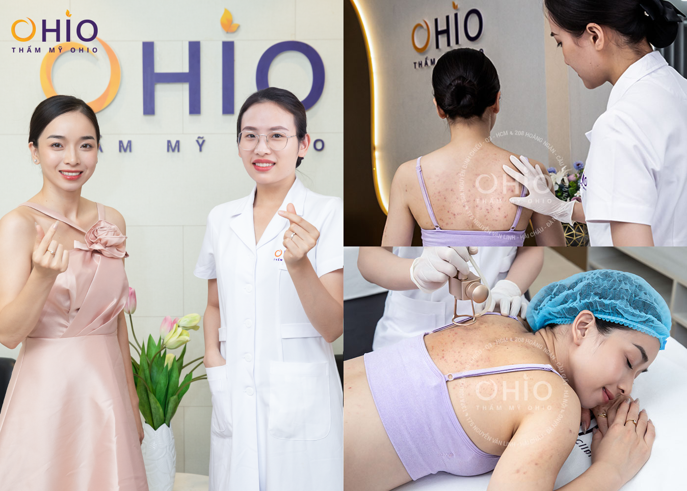 Cách trị mụn lưng an toàn, hiệu quả - Phòng khám da liễu OHIO Cách trị mụn lưng an toàn, hiệu quả