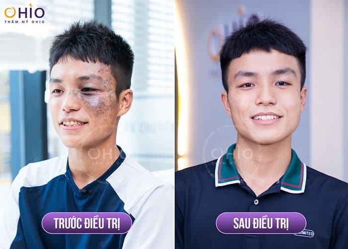 Phương pháp xóa chàm bớt đen hiệu quả mà không cảm thấy đau đớn