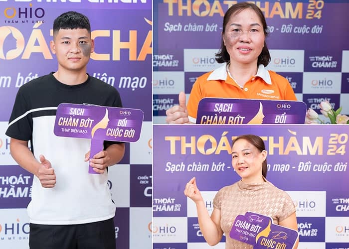 Phương pháp xóa chàm bớt đen hiệu quả mà không cảm thấy đau đớn
