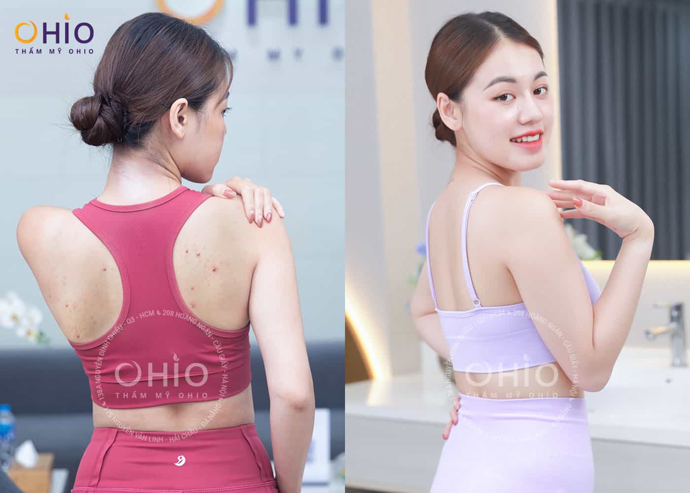 Cách trị mụn lưng an toàn, hiệu quả - Phòng khám da liễu OHIO Cách trị mụn lưng an toàn, hiệu quả