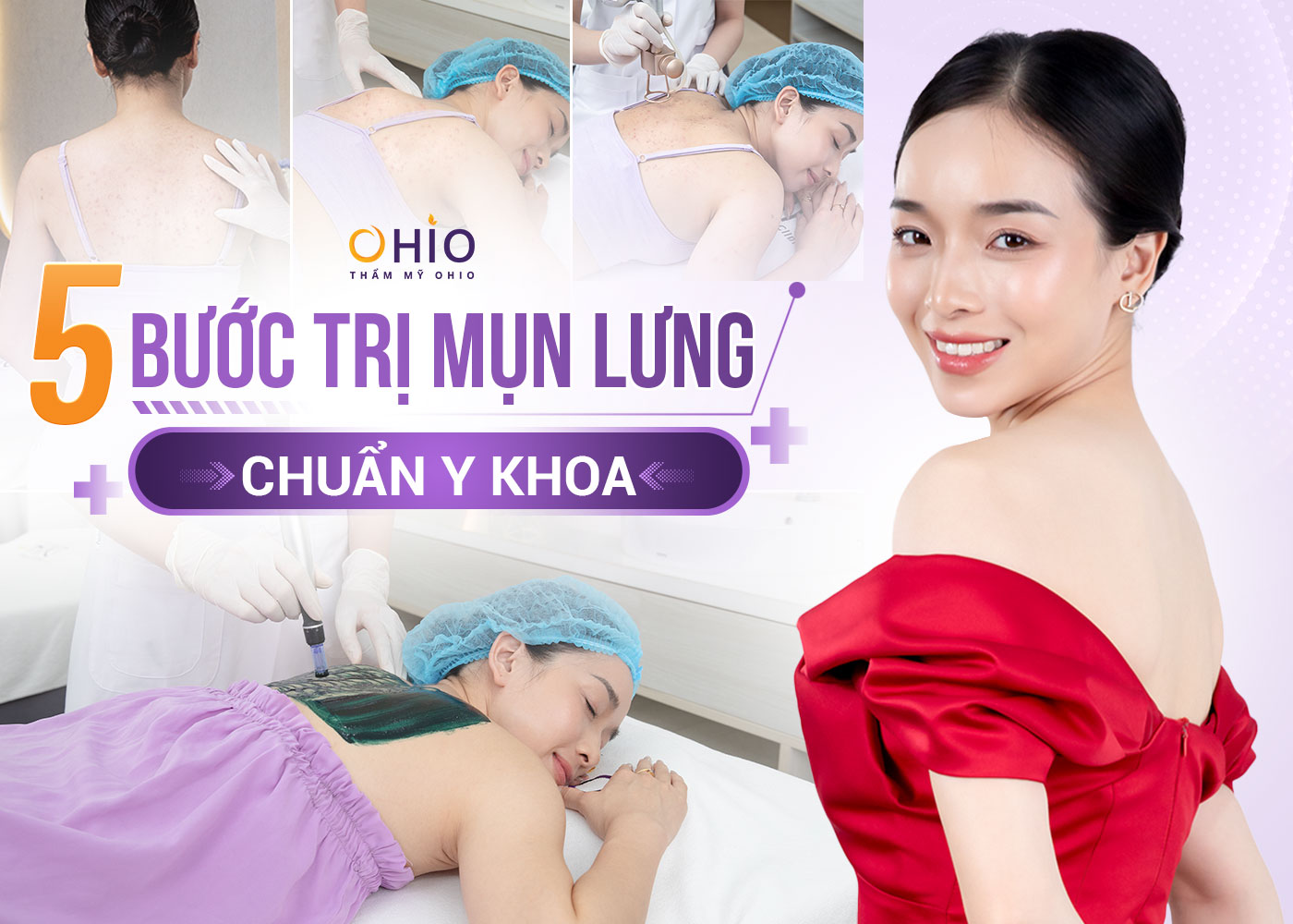 Cách trị mụn lưng an toàn, hiệu quả - Phòng khám da liễu OHIO quy trình trị mụn lưng