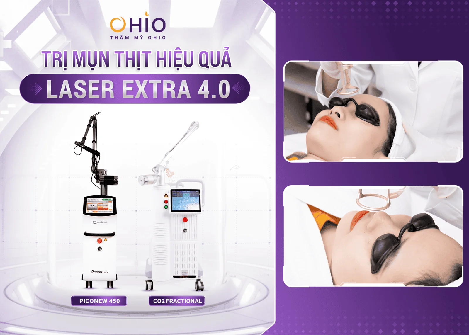 Trị mụn thịt công nghệ Laser Extra: Hiệu quả, an toàn - Phòng khám da liễu OHIO Trị mụn thịt công nghệ Laser Extra: Hiệu quả, an toàn