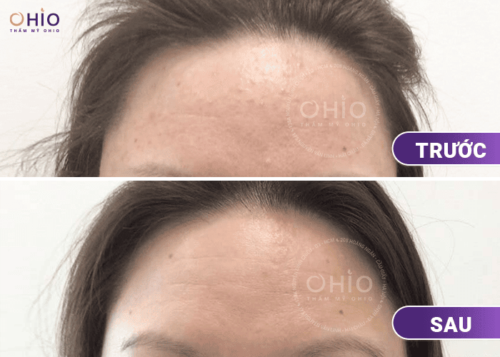Trị mụn thịt công nghệ Laser Extra: Hiệu quả, an toàn - Phòng khám da liễu OHIO Trị mụn thịt công nghệ Laser Extra: Hiệu quả, an toàn