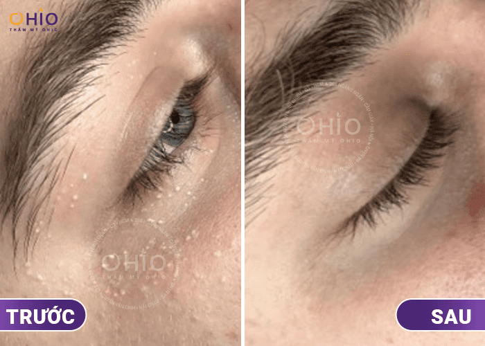 Trị mụn thịt công nghệ Laser Extra: Hiệu quả, an toàn - Phòng khám da liễu OHIO Trị mụn thịt công nghệ Laser Extra: Hiệu quả, an toàn