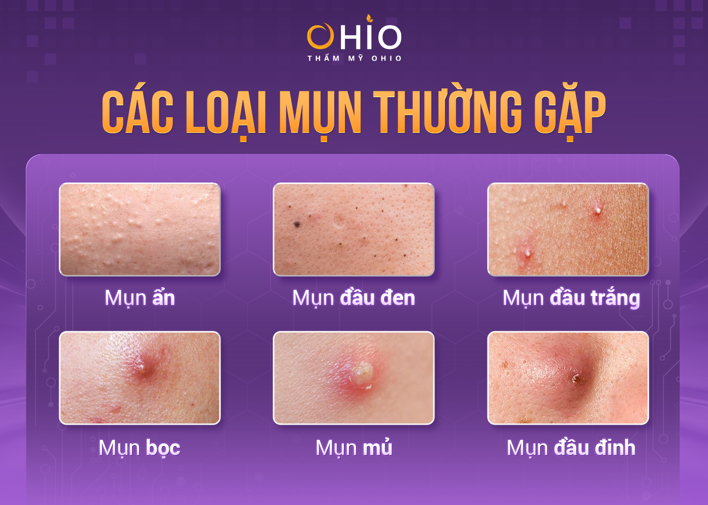 Trị mụn trứng cá Azumino Acne hiệu quả, an toàn - Phòng khám da liễu OHIO các loại mụn trứng cá