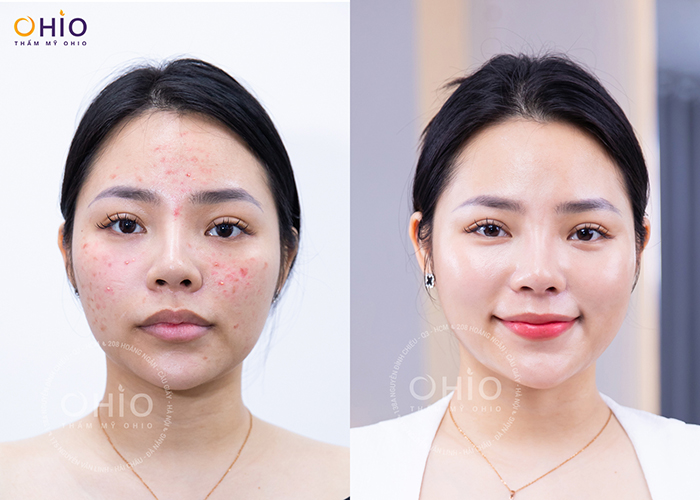 Trị mụn trứng cá Azumino Acne hiệu quả, an toàn - Phòng khám da liễu OHIO Trị mụn trứng cá Azumino Acne hiệu quả, an toàn