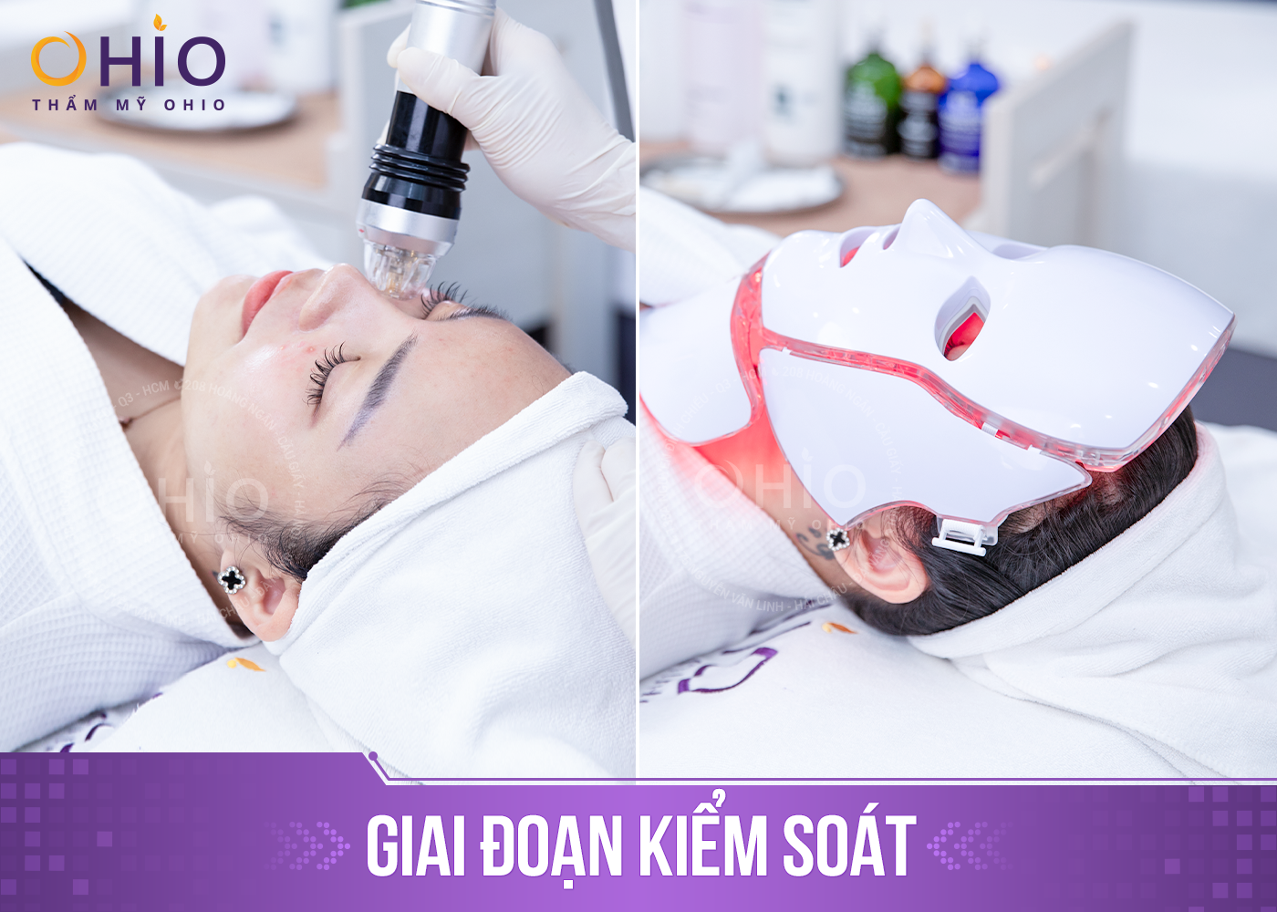 Trị mụn trứng cá Azumino Acne hiệu quả, an toàn - Phòng khám da liễu OHIO Trị mụn trứng cá Azumino Acne hiệu quả, an toàn