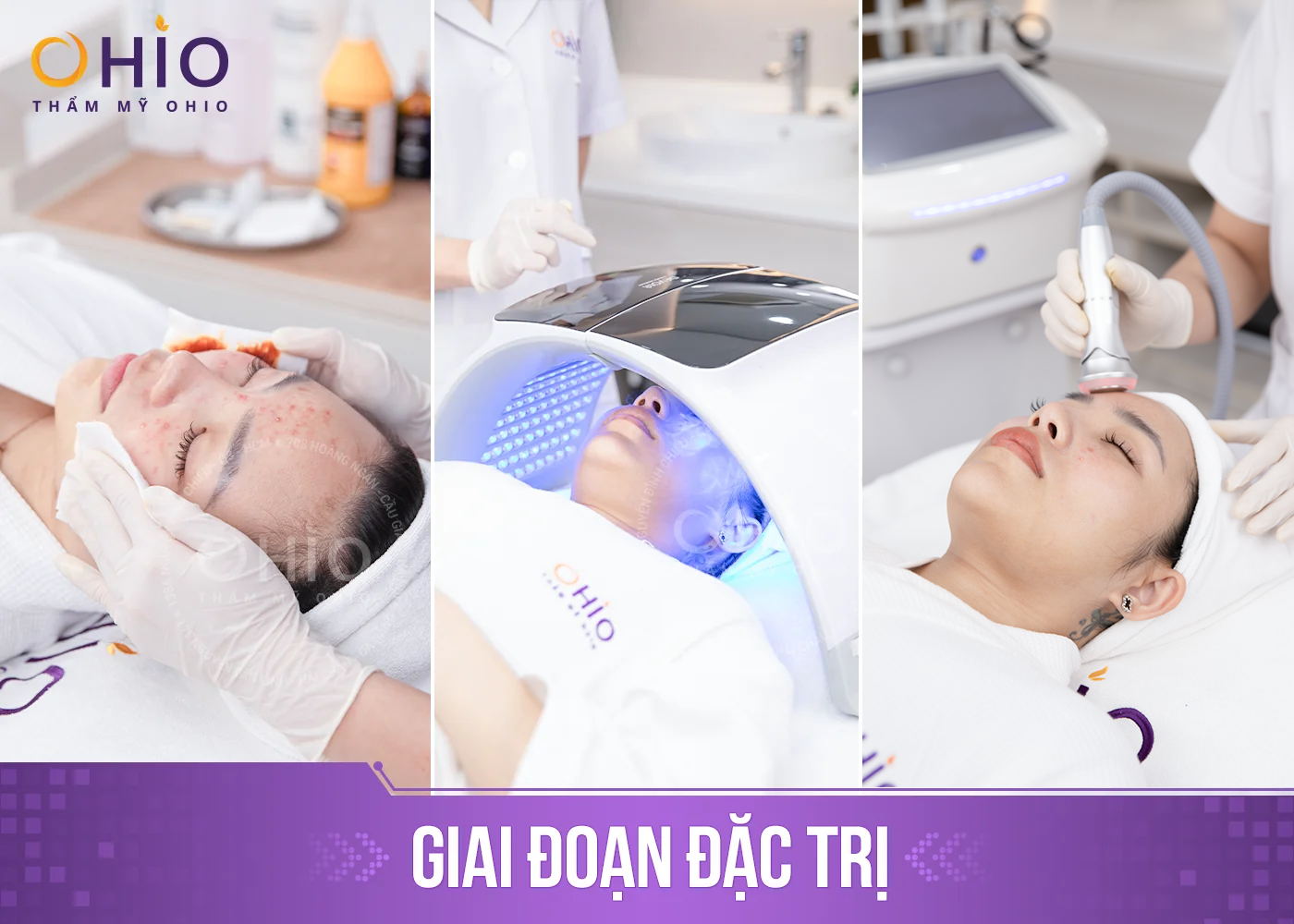 Trị mụn trứng cá Azumino Acne hiệu quả, an toàn - Phòng khám da liễu OHIO Trị mụn trứng cá Azumino Acne hiệu quả, an toàn