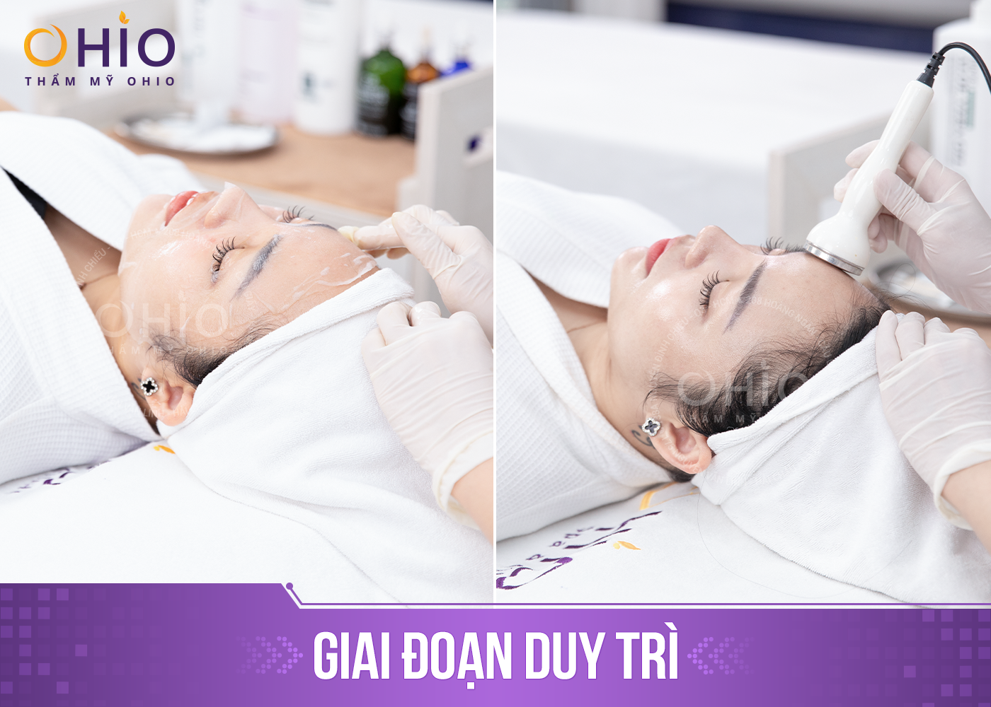 Trị mụn trứng cá Azumino Acne hiệu quả, an toàn - Phòng khám da liễu OHIO Trị mụn trứng cá Azumino Acne hiệu quả, an toàn