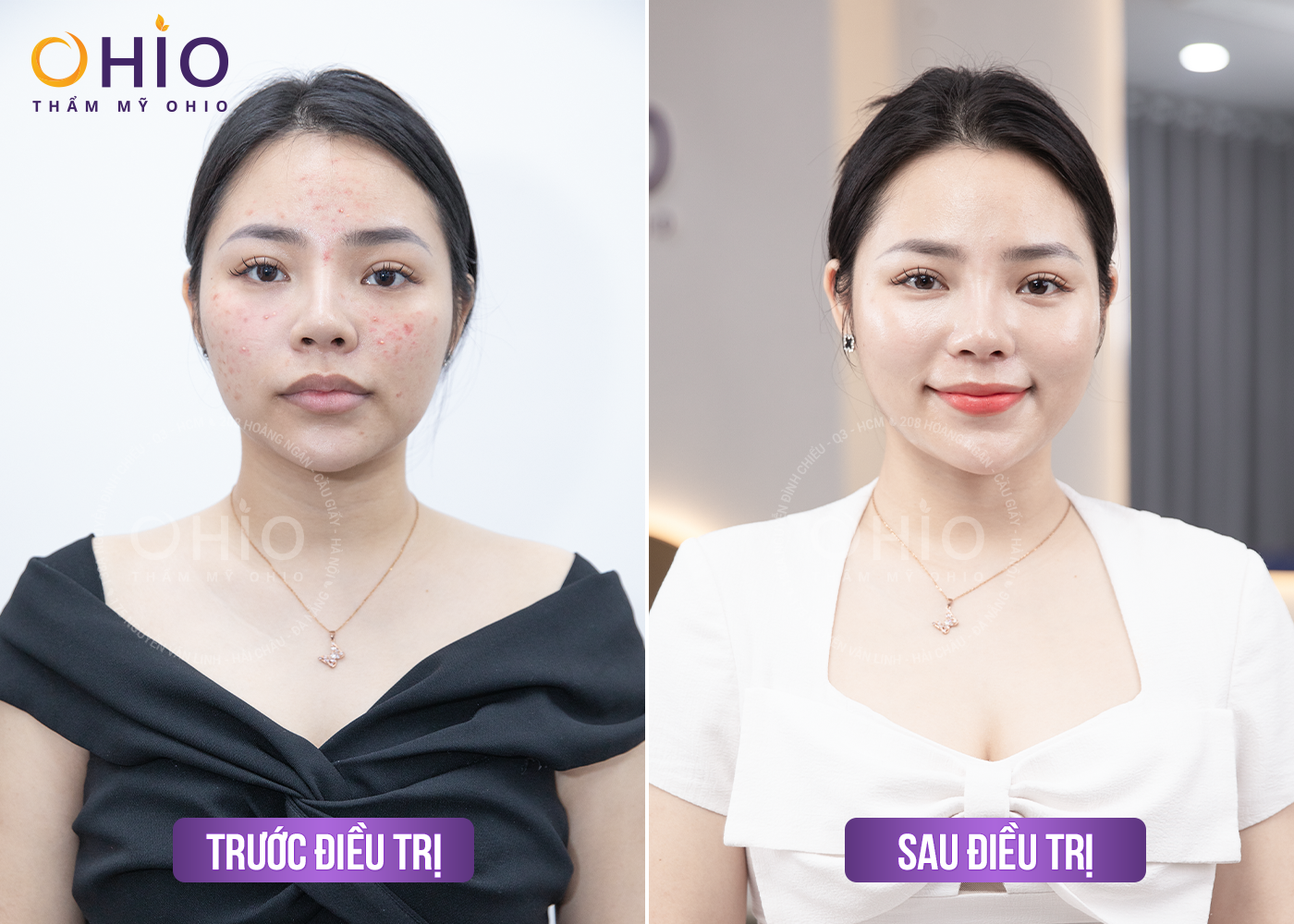 Trị mụn trứng cá Azumino Acne hiệu quả, an toàn - Phòng khám da liễu OHIO Trị mụn trứng cá Azumino Acne hiệu quả, an toàn