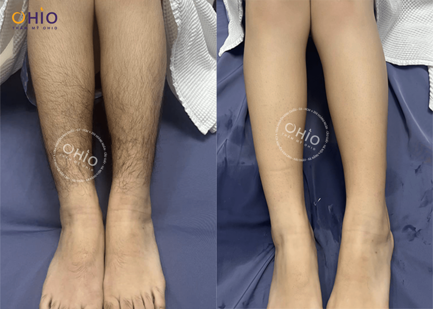 Có nên triệt lông chân bằng công nghệ Diode Laser AI - Phòng khám da liễu OHIO Có nên triệt lông chân bằng công nghệ Diode Laser AI