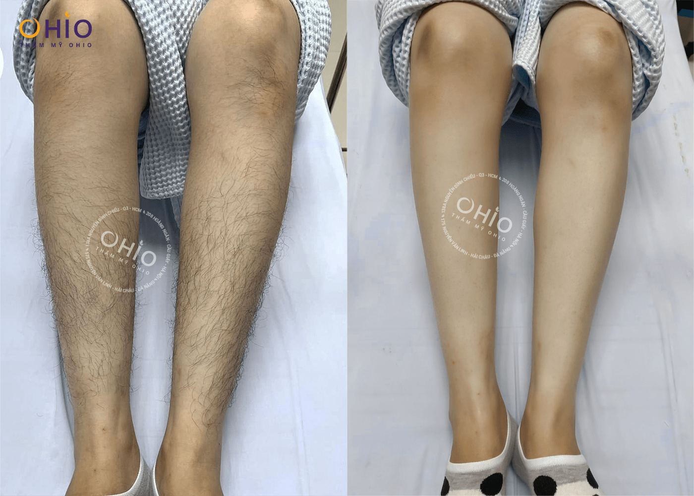 Có nên triệt lông chân bằng công nghệ Diode Laser AI - Phòng khám da liễu OHIO Có nên triệt lông chân bằng công nghệ Diode Laser AI