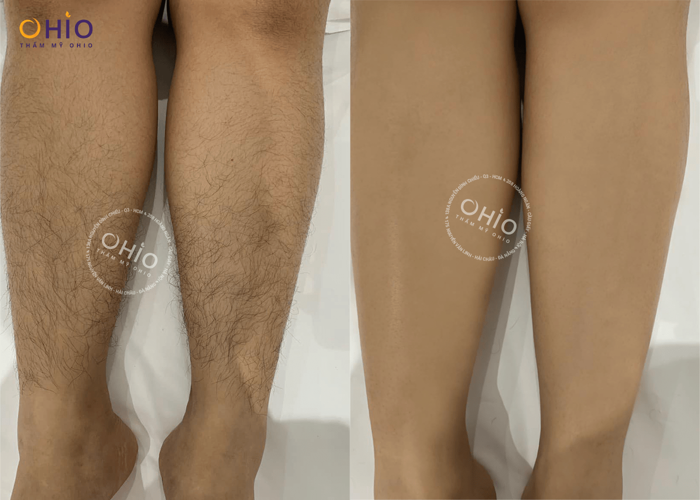 Có nên triệt lông chân bằng công nghệ Diode Laser AI - Phòng khám da liễu OHIO Có nên triệt lông chân bằng công nghệ Diode Laser AI