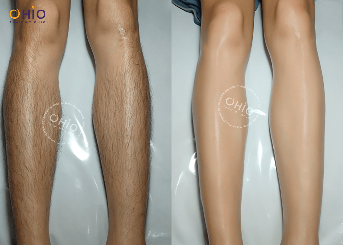 Có nên triệt lông chân bằng công nghệ Diode Laser AI - Phòng khám da liễu OHIO Có nên triệt lông chân bằng công nghệ Diode Laser AI