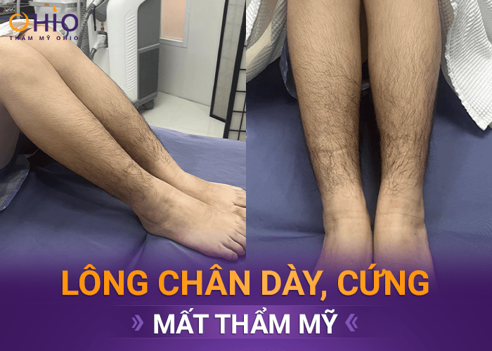 Có nên triệt lông chân bằng công nghệ Diode Laser AI - Phòng khám da liễu OHIO triệt lông chân hiệu quả