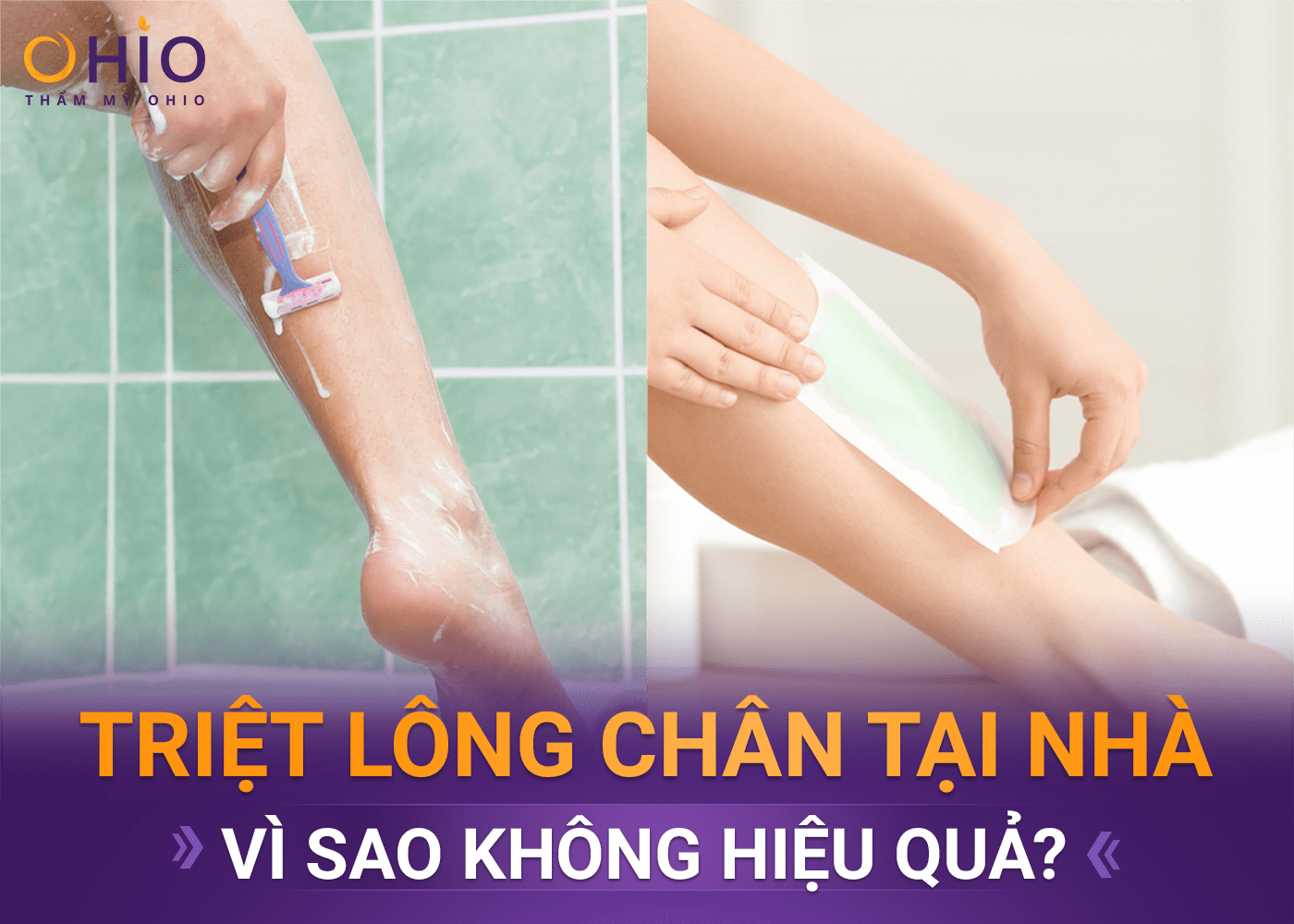 Có nên triệt lông chân bằng công nghệ Diode Laser AI - Phòng khám da liễu OHIO Có nên triệt lông chân bằng công nghệ Diode Laser AI
