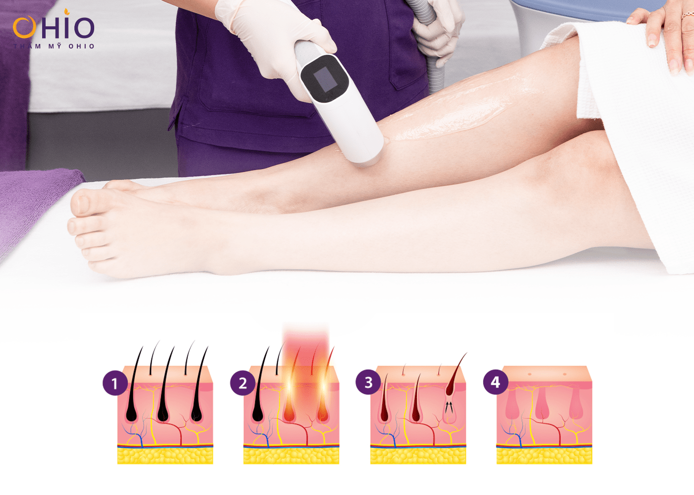 Có nên triệt lông chân bằng công nghệ Diode Laser AI - Phòng khám da liễu OHIO Có nên triệt lông chân bằng công nghệ Diode Laser AI