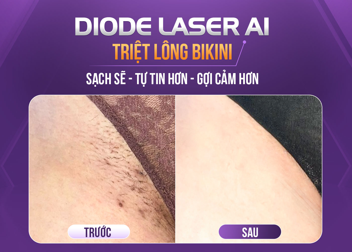 Triệt lông bikini với công nghệ Diode Laser AI tại Phòng khám OHIO
