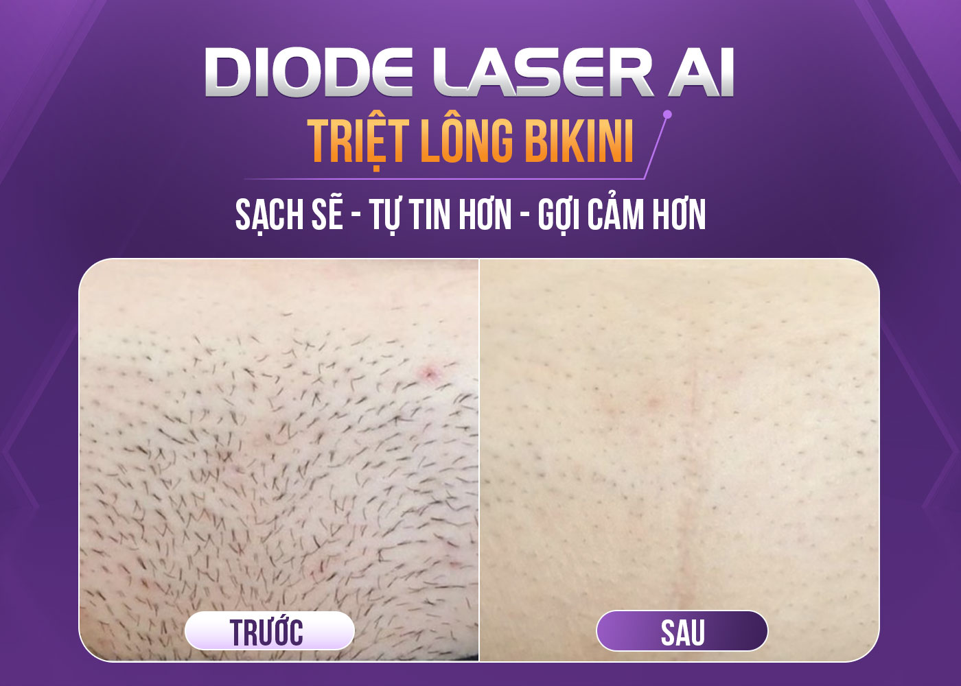 Triệt lông bikini với công nghệ Diode Laser AI tại Phòng khám OHIO