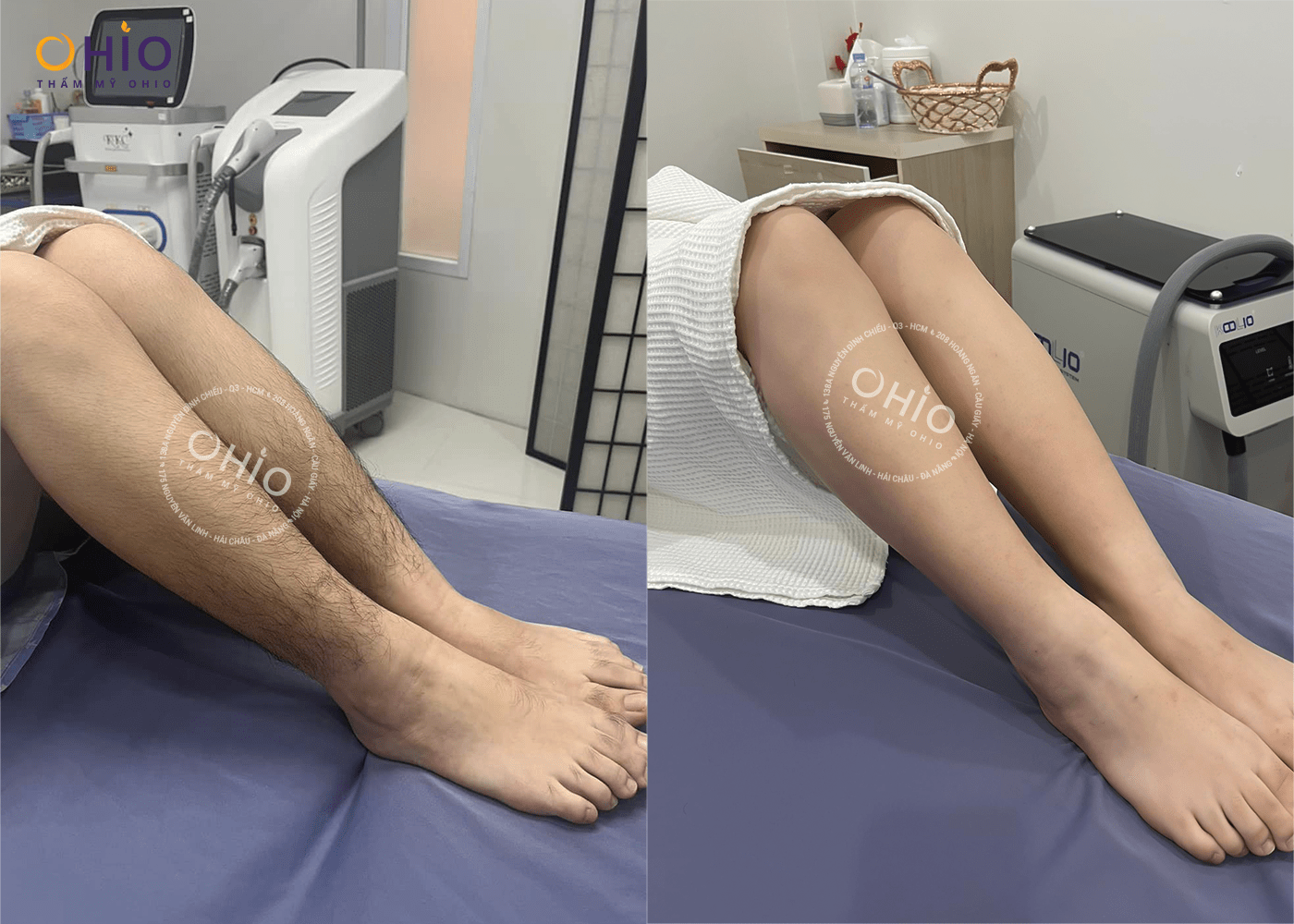 Có nên triệt lông chân bằng công nghệ Diode Laser AI - Phòng khám da liễu OHIO Có nên triệt lông chân bằng công nghệ Diode Laser AI