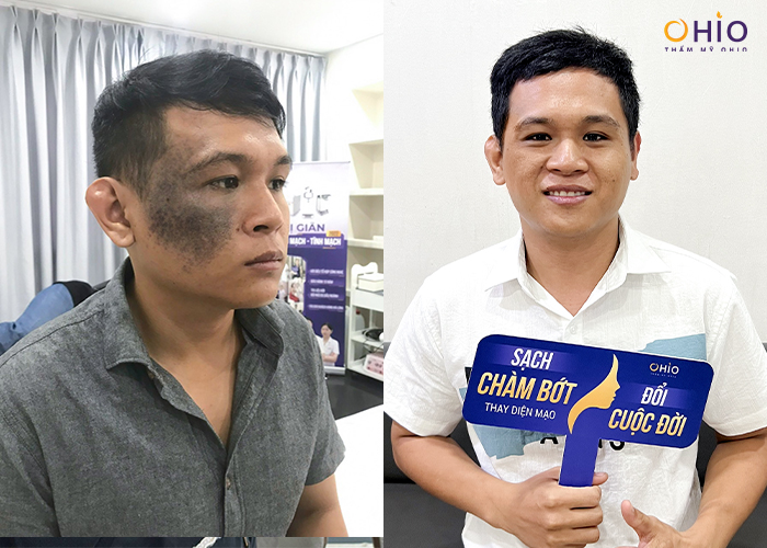 Chiến dịch Thoát Chàm 2024 giúp hàng ngàn người thay diện mạo, đổi cuộc đời - Phòng khám da liễu OHIO Chiến dịch Thoát Chàm 2024 giúp hàng ngàn người thay diện mạo, đổi cuộc đời