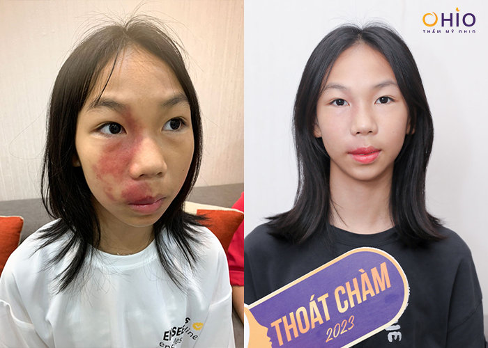 Chiến dịch Thoát Chàm 2024 giúp hàng ngàn người thay diện mạo, đổi cuộc đời - Phòng khám da liễu OHIO Chiến dịch Thoát Chàm 2024 giúp hàng ngàn người thay diện mạo, đổi cuộc đời