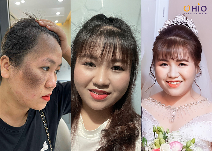 Chiến dịch Thoát Chàm 2024 giúp hàng ngàn người thay diện mạo, đổi cuộc đời - Phòng khám da liễu OHIO Chiến dịch Thoát Chàm 2024 giúp hàng ngàn người thay diện mạo, đổi cuộc đời