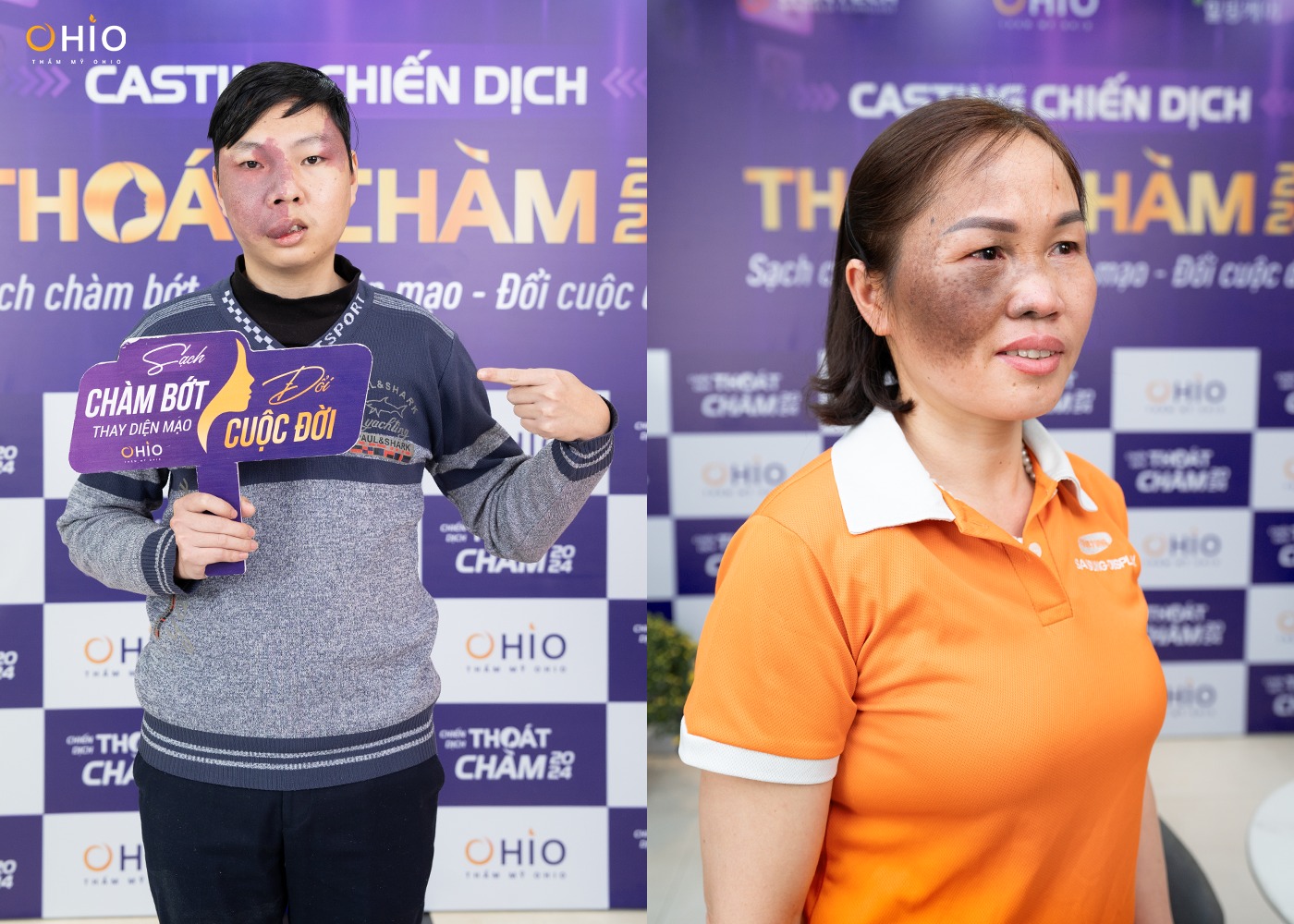 Hàng ngàn thí sinh “đổ về” casting “Chiến dịch thoát chàm” 2024 - Phòng khám da liễu OHIO Hàng ngàn thí sinh “đổ về” casting “Chiến dịch thoát chàm” 2024