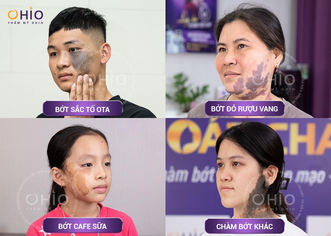 Hàng ngàn thí sinh “đổ về” casting “Chiến dịch thoát chàm” 2024 - Phòng khám da liễu OHIO Hàng ngàn thí sinh “đổ về” casting “Chiến dịch thoát chàm” 2024