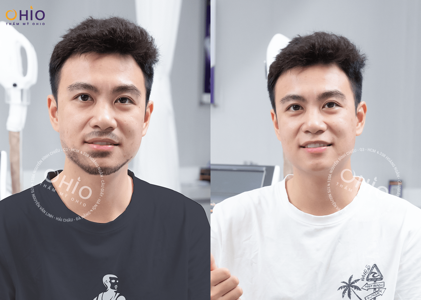 Triệt râu quai nón hiệu quả và những điều nam giới cần biết - Phòng khám da liễu OHIO Triệt râu quai nón hiệu quả và những điều nam giới cần biết