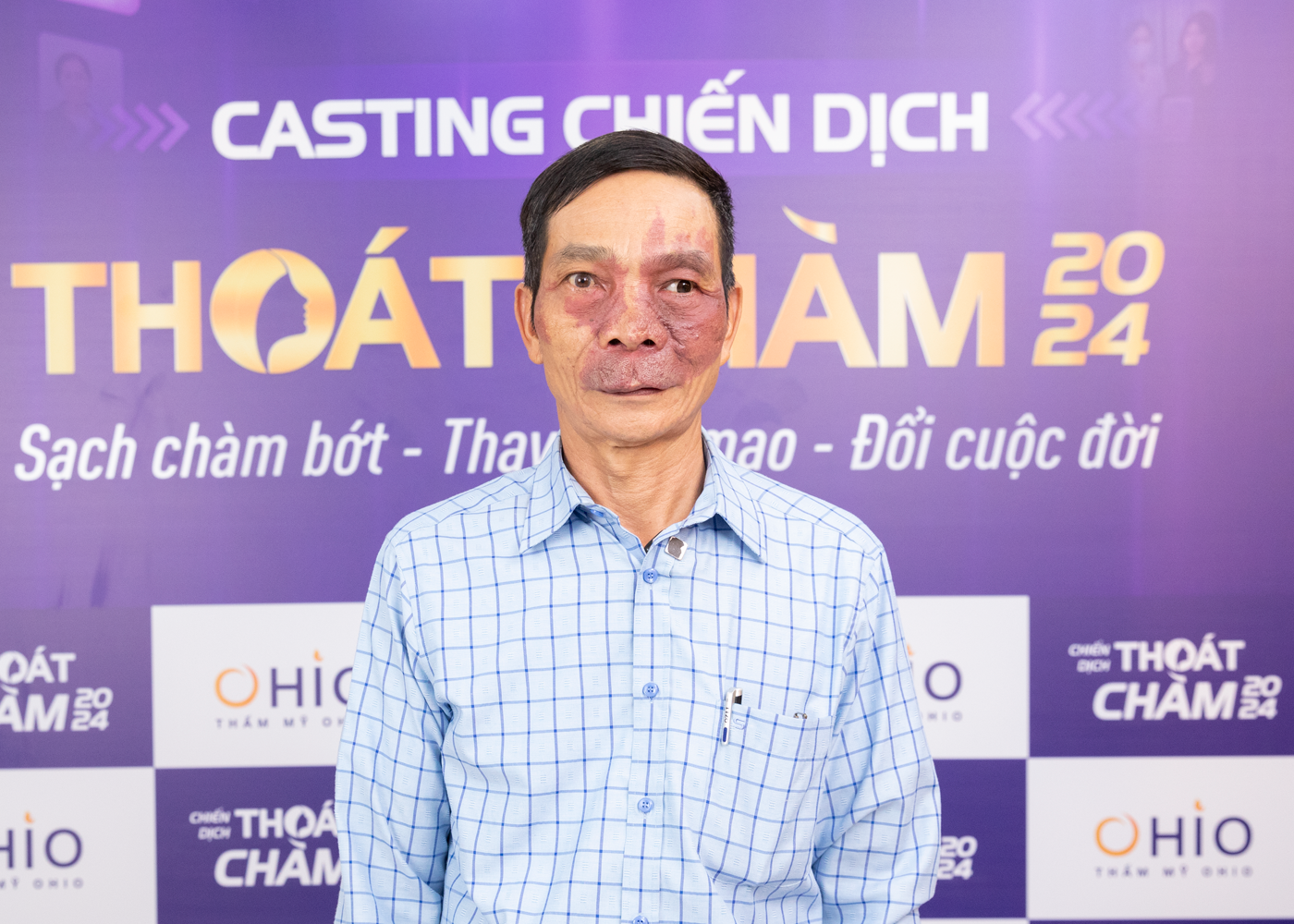 Chiến dịch Thoát chàm 2024 thực hiện hoá ước mơ cho những bệnh nhân chàm bớt sắc tố - Phòng khám da liễu OHIO Chiến dịch Thoát chàm 2024 thực hiện hoá ước mơ cho những bệnh nhân chàm bớt sắc tố