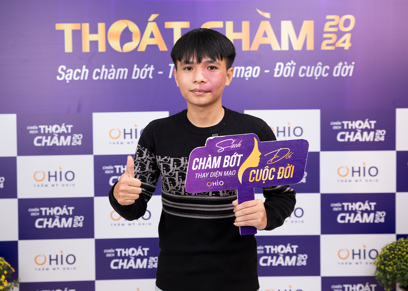 Chiến dịch Thoát chàm 2024 thực hiện hoá ước mơ cho những bệnh nhân chàm bớt sắc tố - Phòng khám da liễu OHIO Chiến dịch Thoát chàm 2024 thực hiện hoá ước mơ cho những bệnh nhân chàm bớt sắc tố