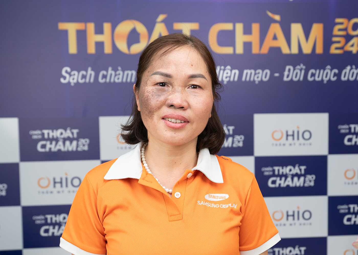 Chiến dịch Thoát chàm 2024 thực hiện hoá ước mơ cho những bệnh nhân chàm bớt sắc tố - Phòng khám da liễu OHIO Chiến dịch Thoát chàm 2024 thực hiện hoá ước mơ cho những bệnh nhân chàm bớt sắc tố