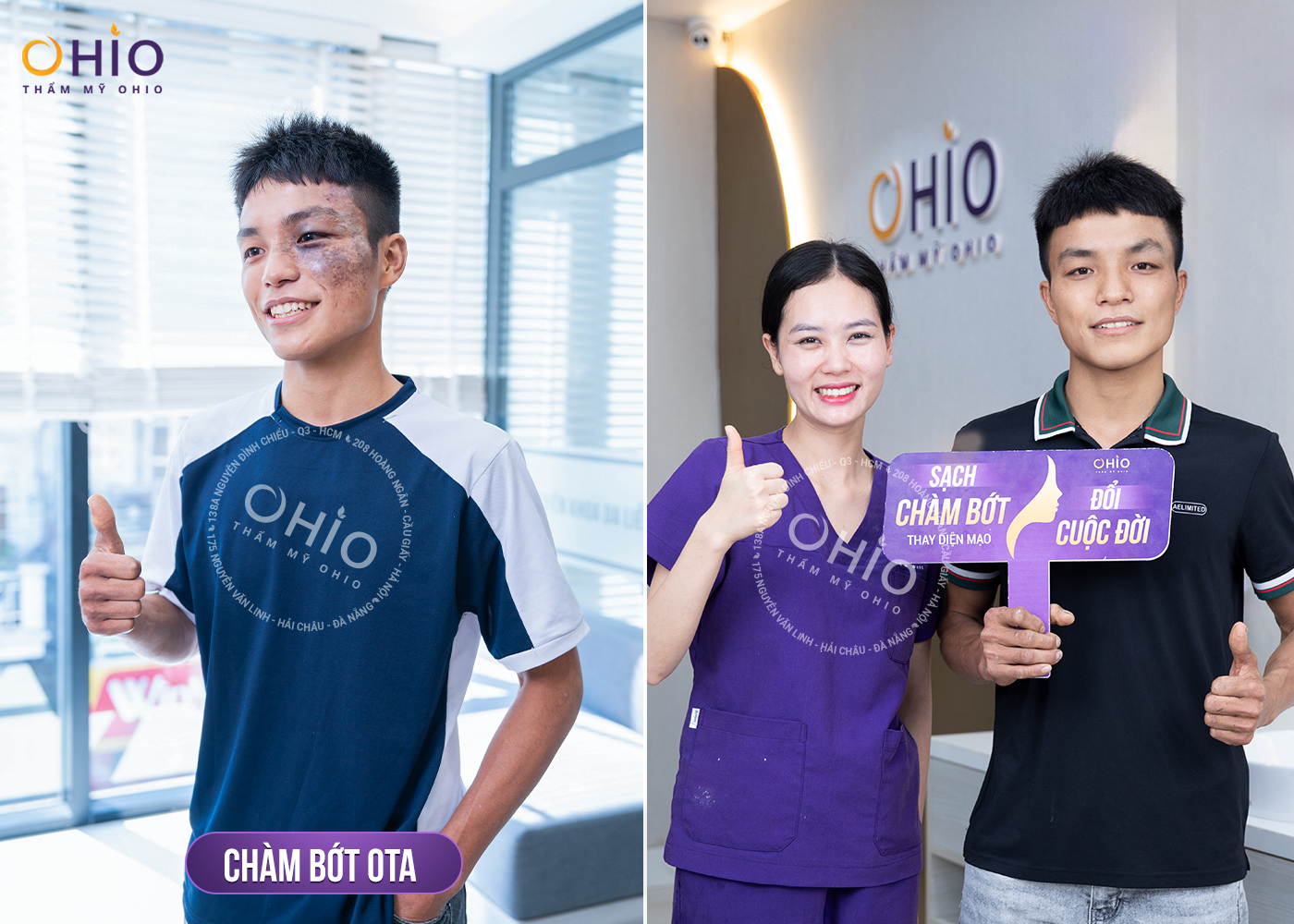 Chiến dịch Thoát chàm 2024 thực hiện hoá ước mơ cho những bệnh nhân chàm bớt sắc tố - Phòng khám da liễu OHIO Chiến dịch Thoát chàm 2024 thực hiện hoá ước mơ cho những bệnh nhân chàm bớt sắc tố