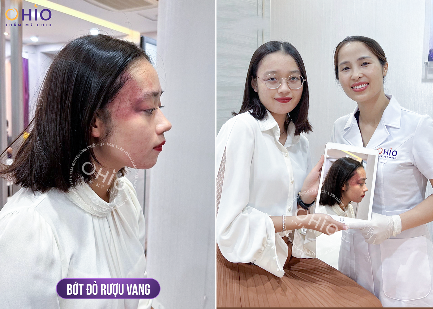 Chiến dịch Thoát chàm 2024 thực hiện hoá ước mơ cho những bệnh nhân chàm bớt sắc tố - Phòng khám da liễu OHIO Chiến dịch Thoát chàm 2024 thực hiện hoá ước mơ cho những bệnh nhân chàm bớt sắc tố